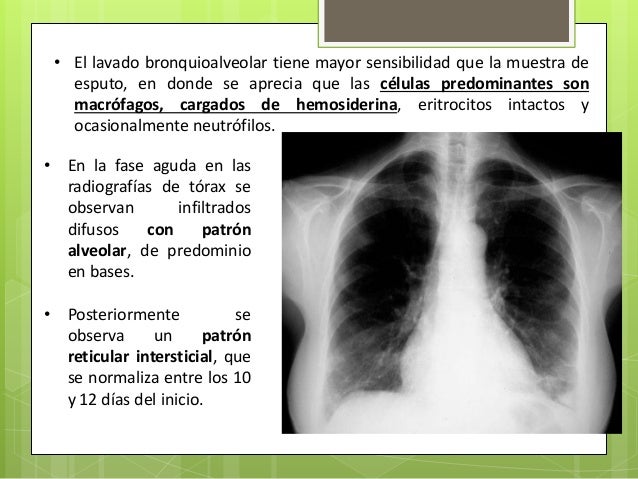 hemosiderosis pulmonar pediatria